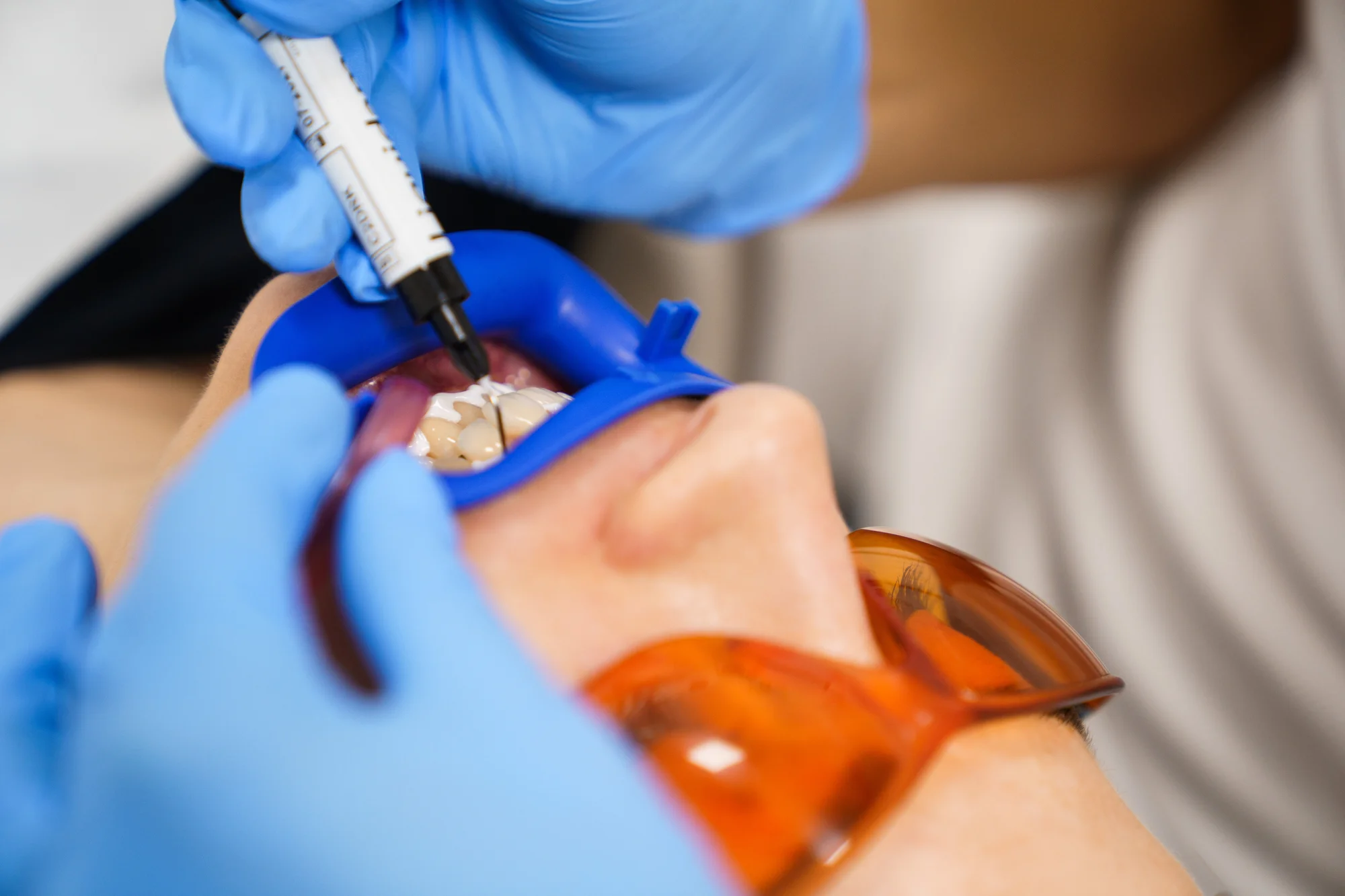 Ordinační bělení zubů LED lampou Philips Zoom s možností dentální hygieny