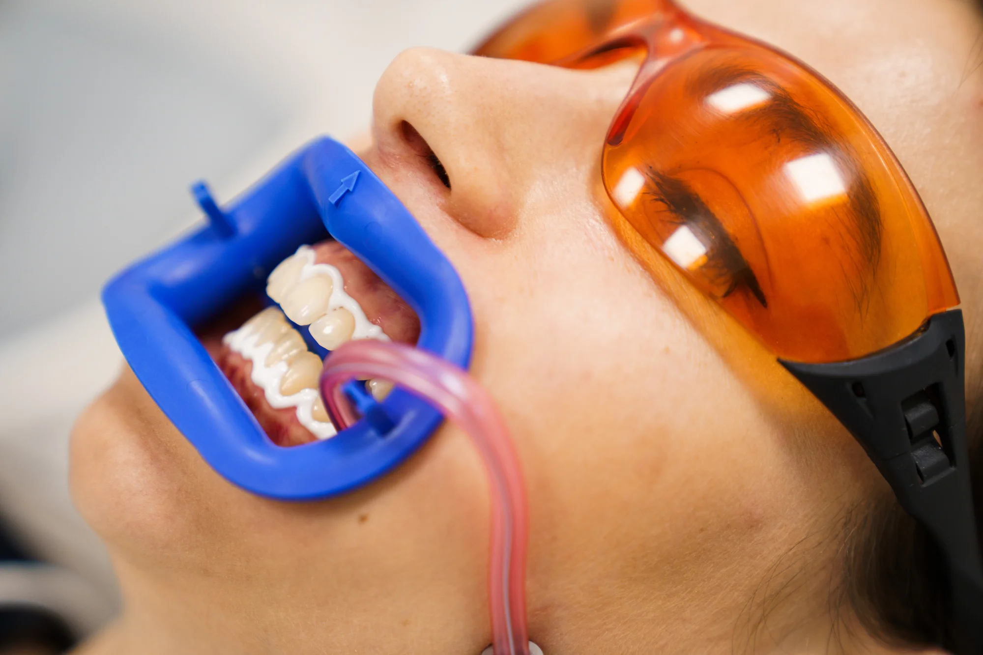 Ordinační bělení zubů LED lampou Philips Zoom s možností dentální hygieny