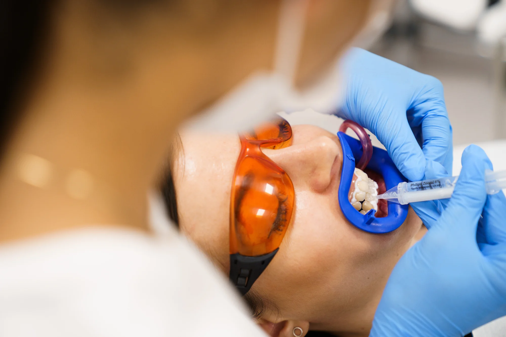 Ordinační bělení zubů LED lampou Philips Zoom s možností dentální hygieny