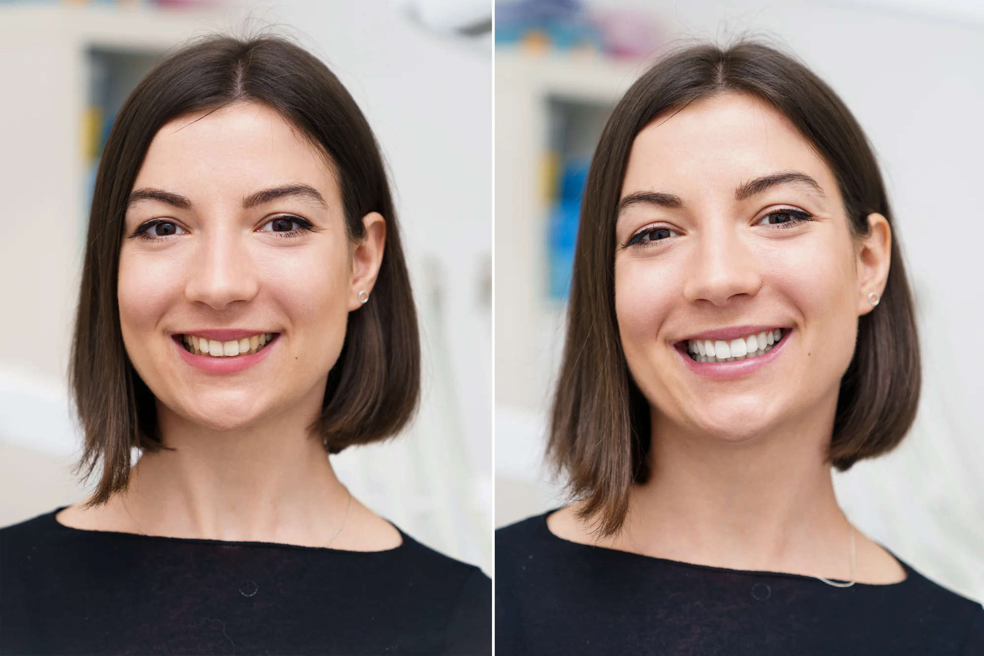 Ordinační bělení zubů LED lampou Philips Zoom s možností dentální hygieny