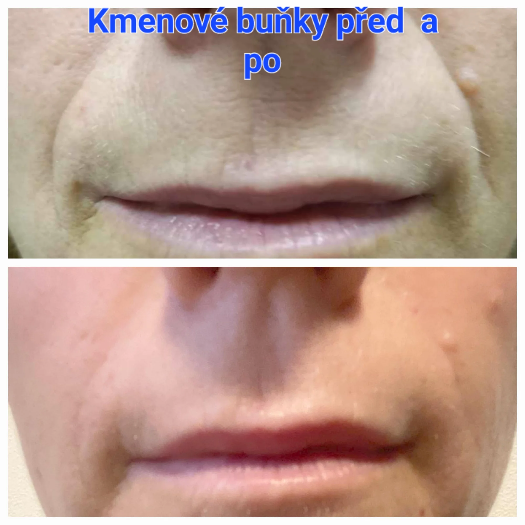 Estetické ošetření dle výběru: kmenové buňky, biorevitalizace i výplň. kys. hyaluronovou