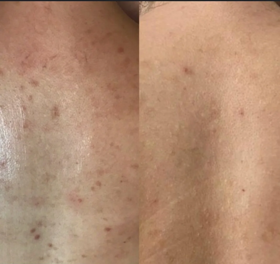 Ošetření AcneTherapy: účinný boj proti akné na obličeji, dekoltu i zádech