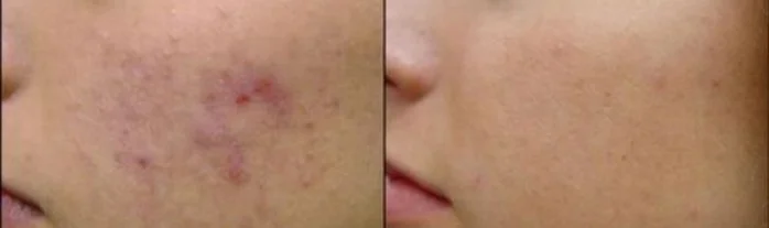Ošetření AcneTherapy: účinný boj proti akné na obličeji, dekoltu i zádech