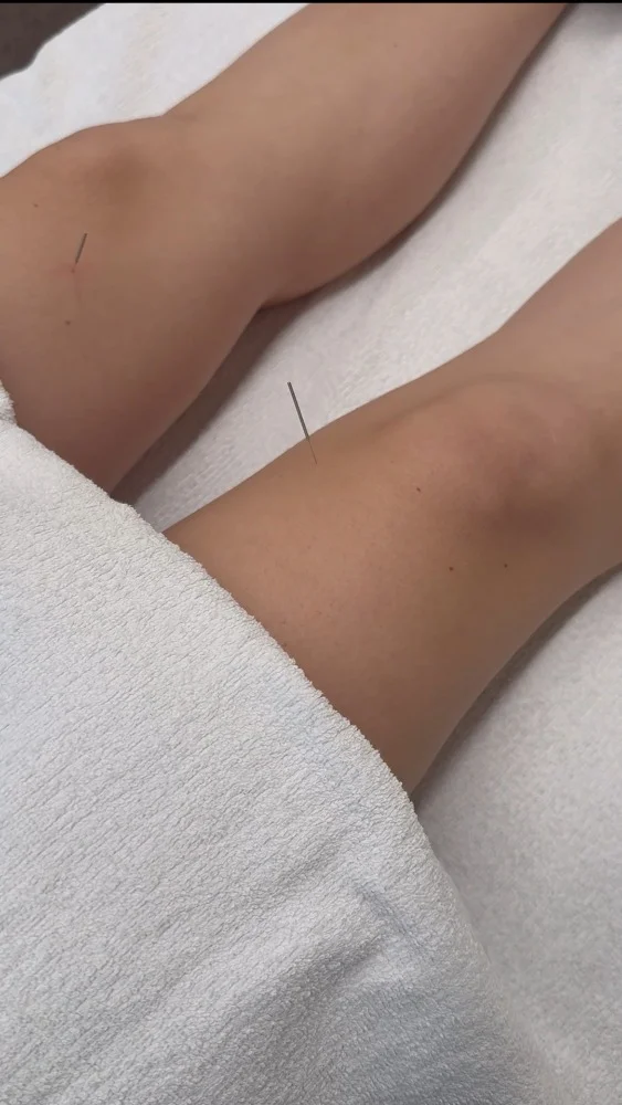 90minutová akupunktura s hloubkovou zdravotní masáží
