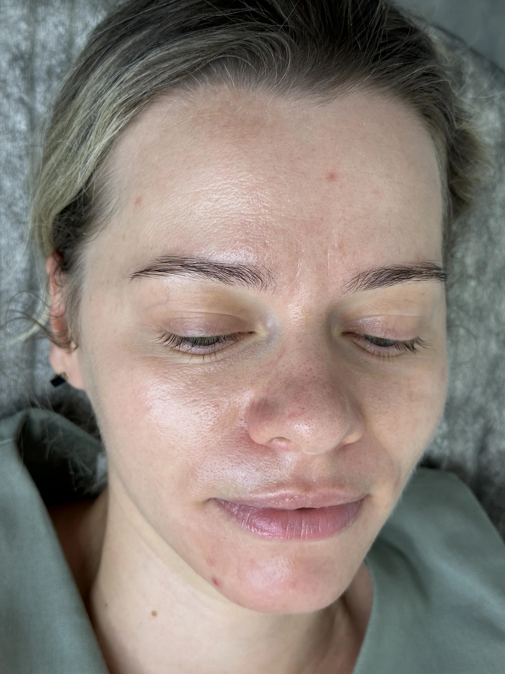 Kosmetické ošetření: ultrazvukové čistění, karboxyterapie, peeling i mikrojehličkování