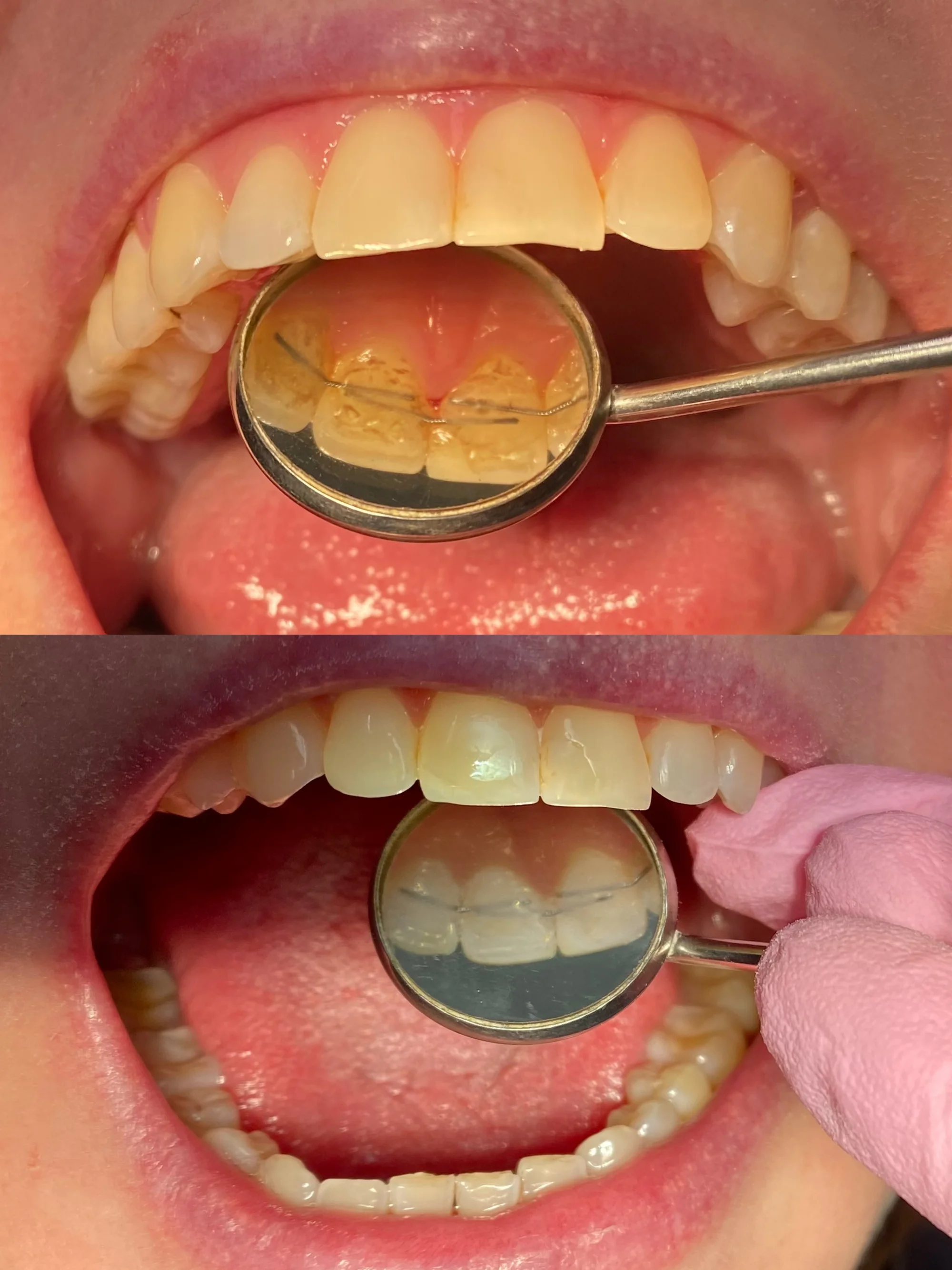Okouzlete zářivým úsměvem: dentální hygiena ve Stodůlkách pro děti i dospělé, vč. možnosti bělení