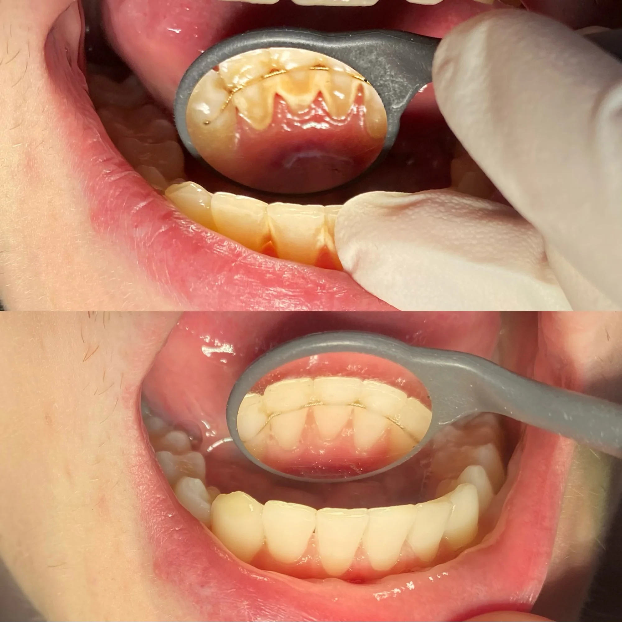 Okouzlete zářivým úsměvem: dentální hygiena ve Stodůlkách pro děti i dospělé, vč. možnosti bělení