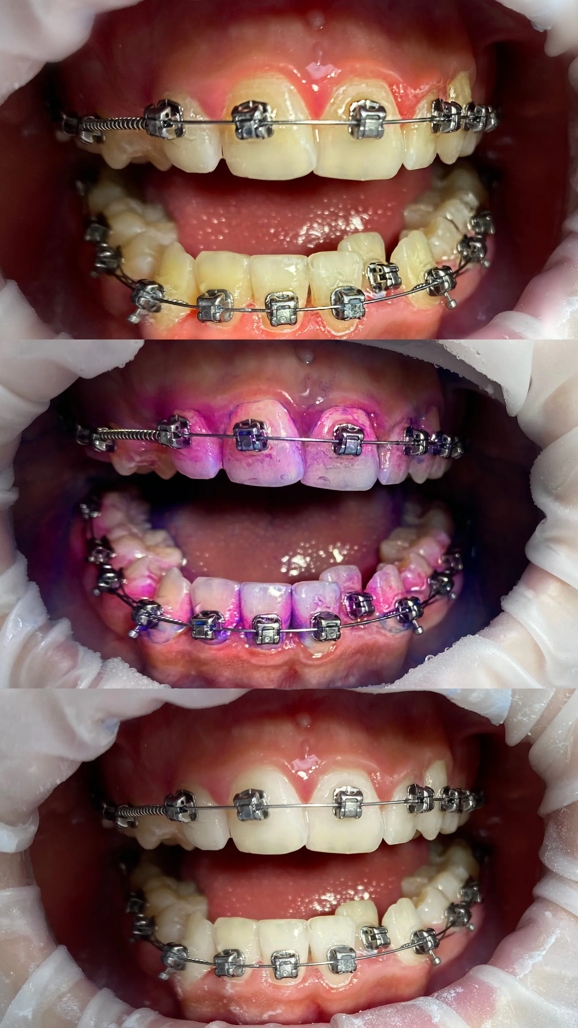 Okouzlete zářivým úsměvem: dentální hygiena ve Stodůlkách pro děti i dospělé, vč. možnosti bělení