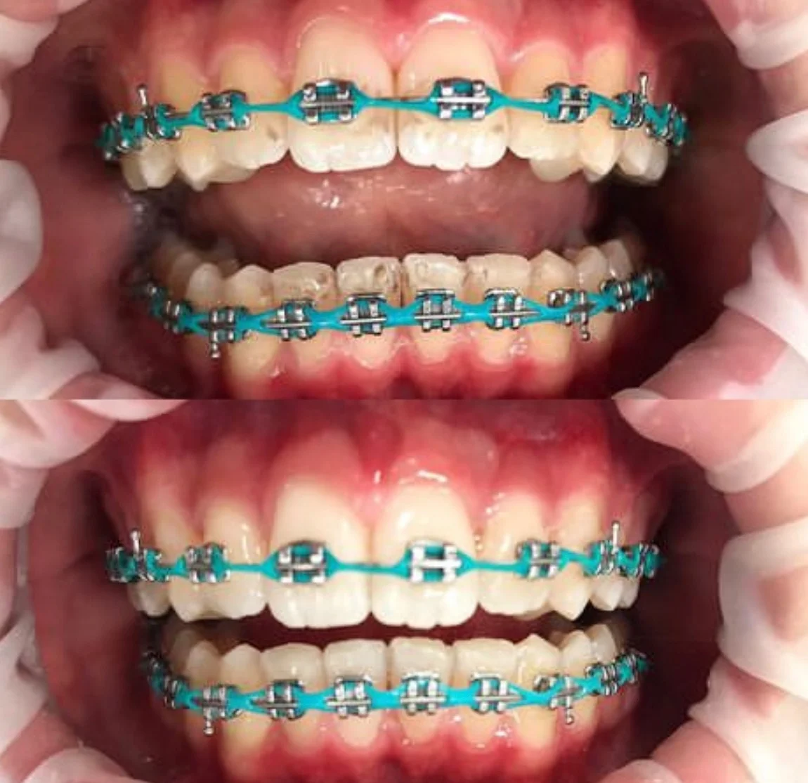 Okouzlete zářivým úsměvem: dentální hygiena ve Stodůlkách pro děti i dospělé, vč. možnosti bělení