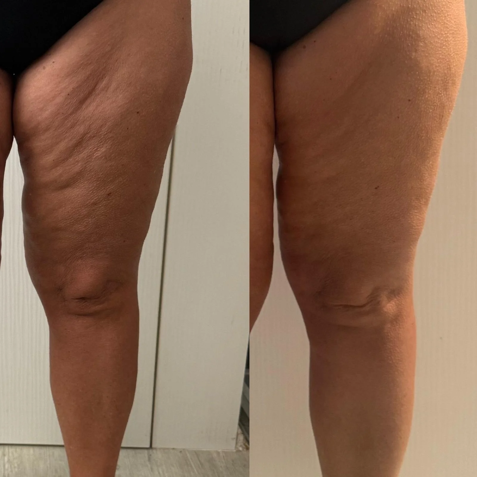 Kompletní ošetření pro tvarování postavy: baňky FUFFU, rollcuping a Vibroslimfit