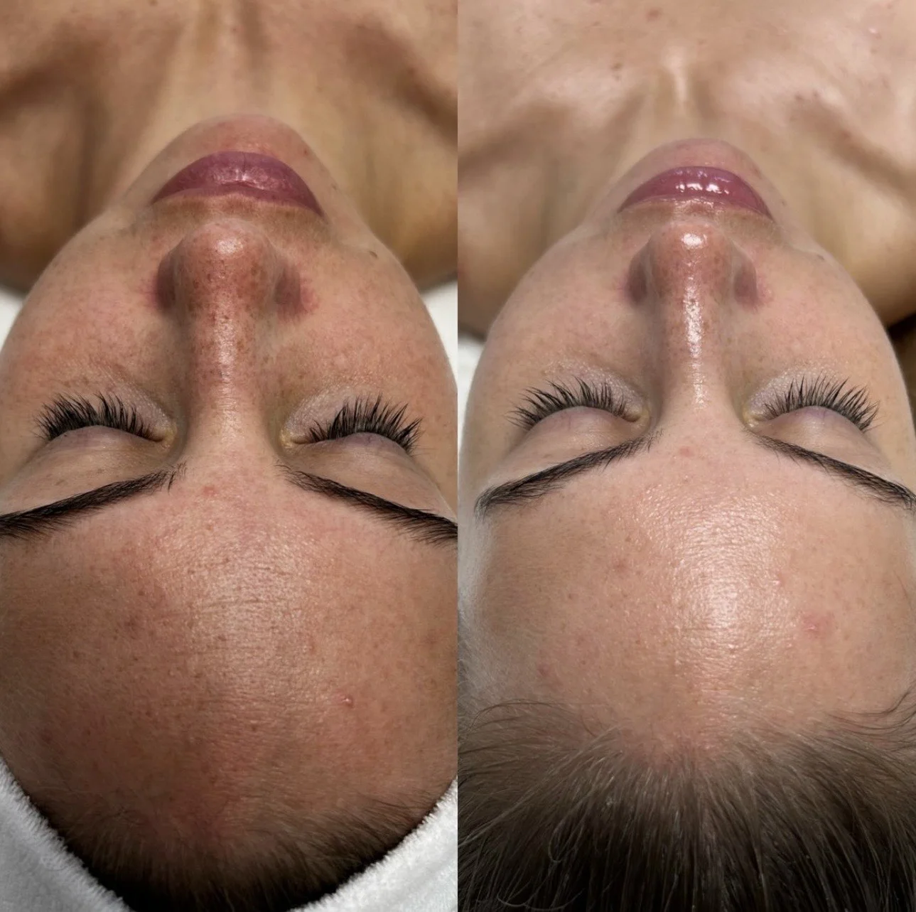 Pleť v nejlepší kondici: anti-age ošetření, bioenzymová terapie či mezoterapie