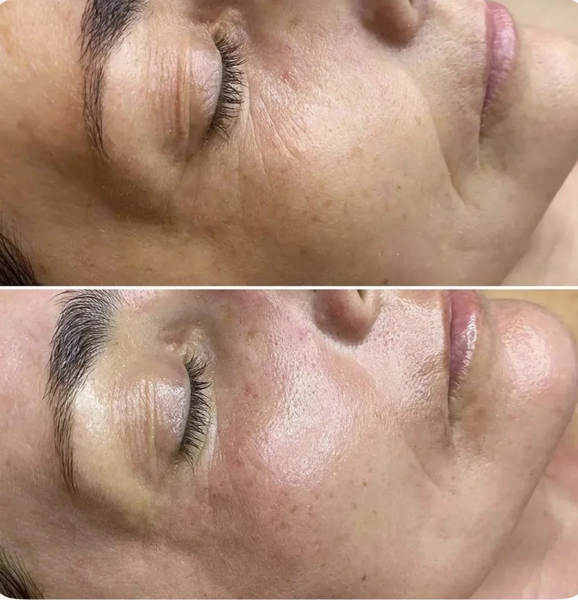 Pleť v nejlepší kondici: anti-age ošetření, bioenzymová terapie či mezoterapie