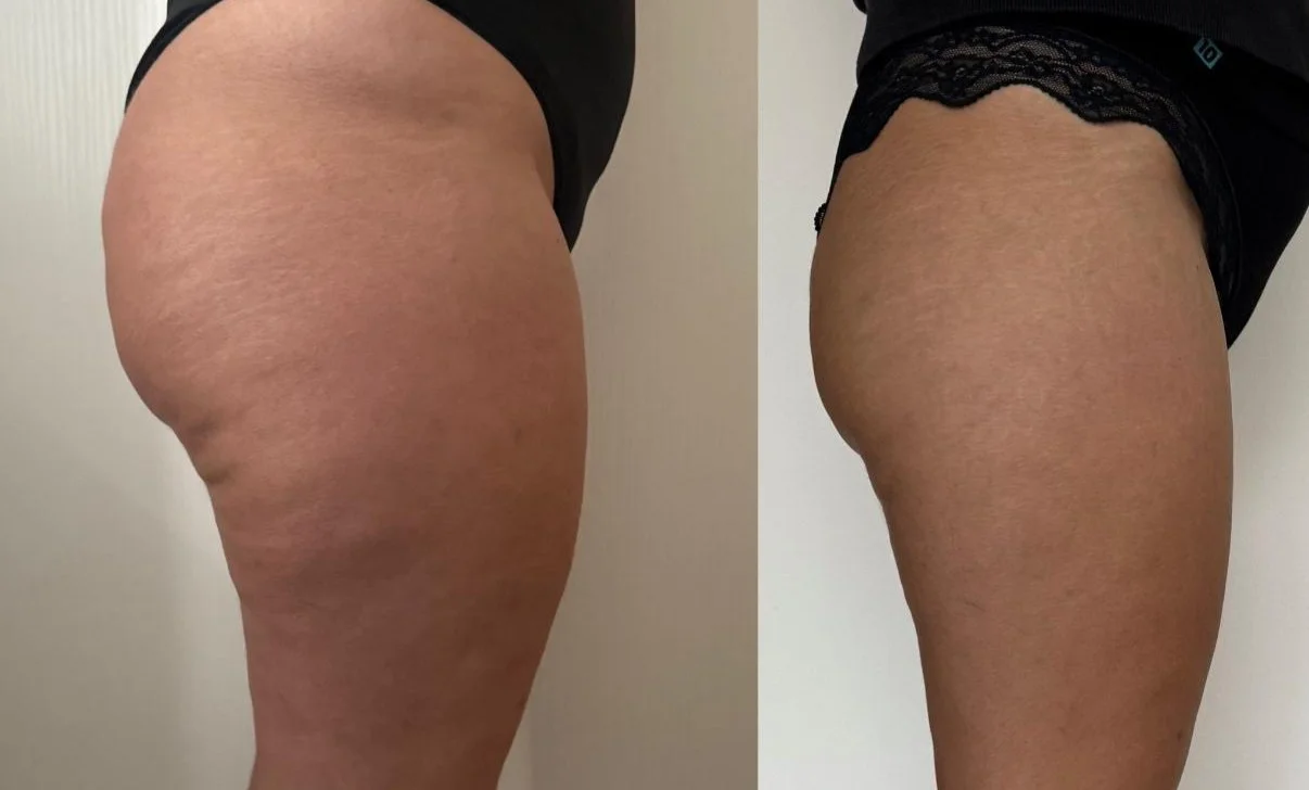 Kompletní ošetření pro tvarování postavy: baňky FUFFU, rollcuping a Vibroslimfit