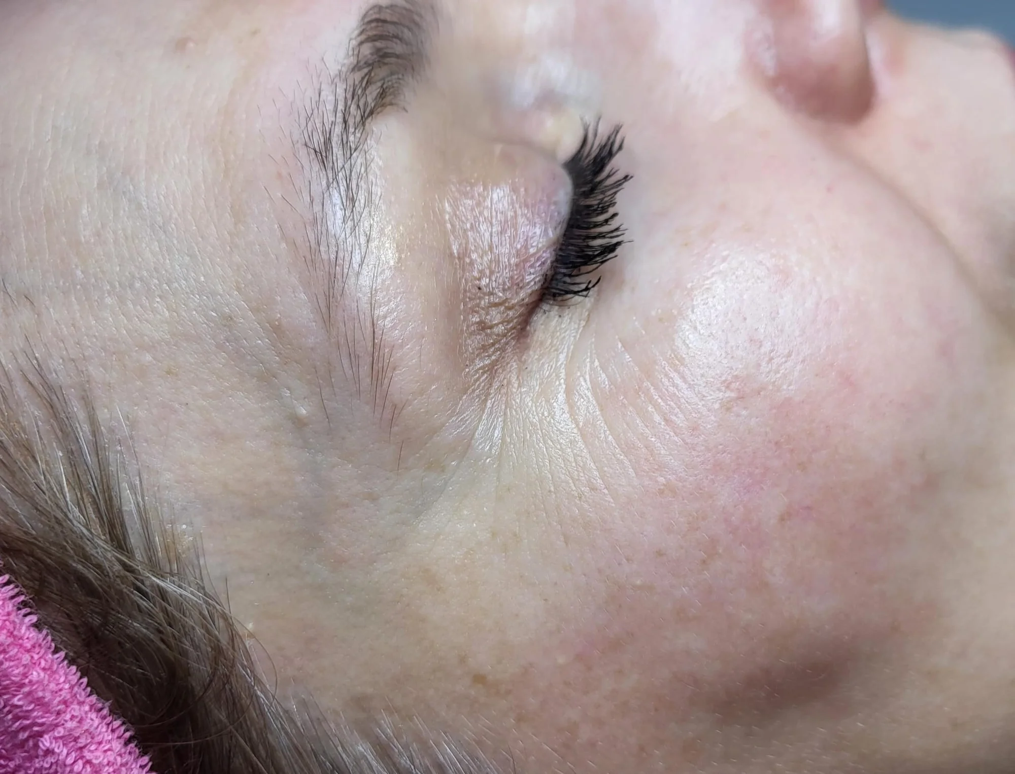 Mikrojehličkování nebo karbonový peeling pro omlazení a obnovu pleti