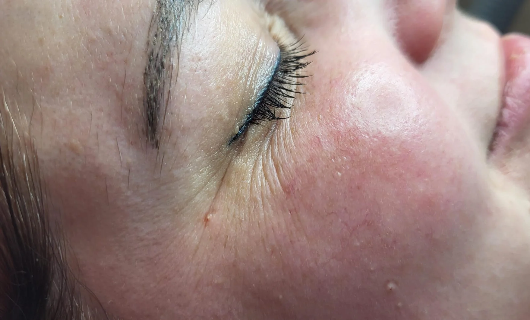 Mikrojehličkování nebo karbonový peeling pro omlazení a obnovu pleti