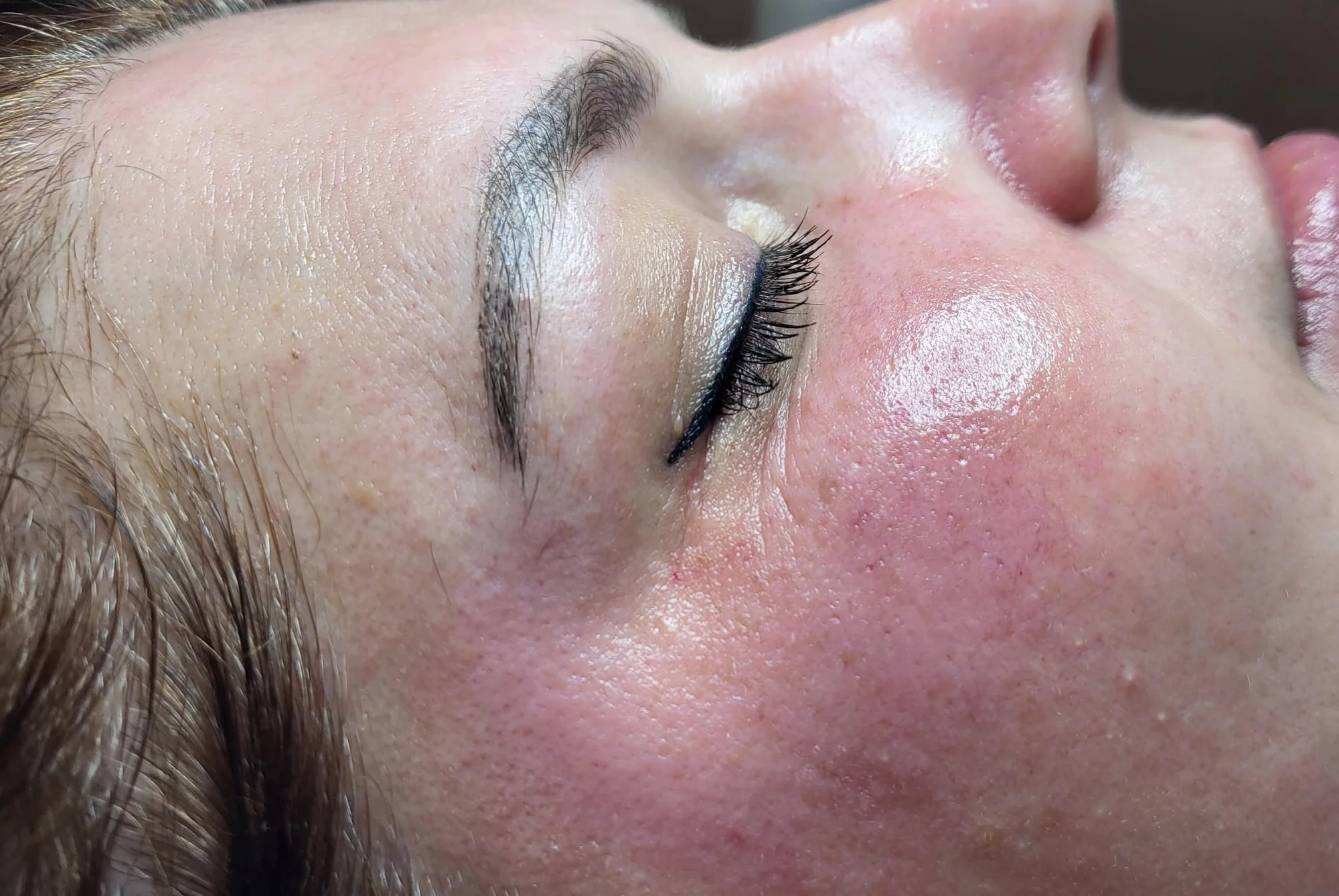 Mikrojehličkování nebo karbonový peeling pro omlazení a obnovu pleti