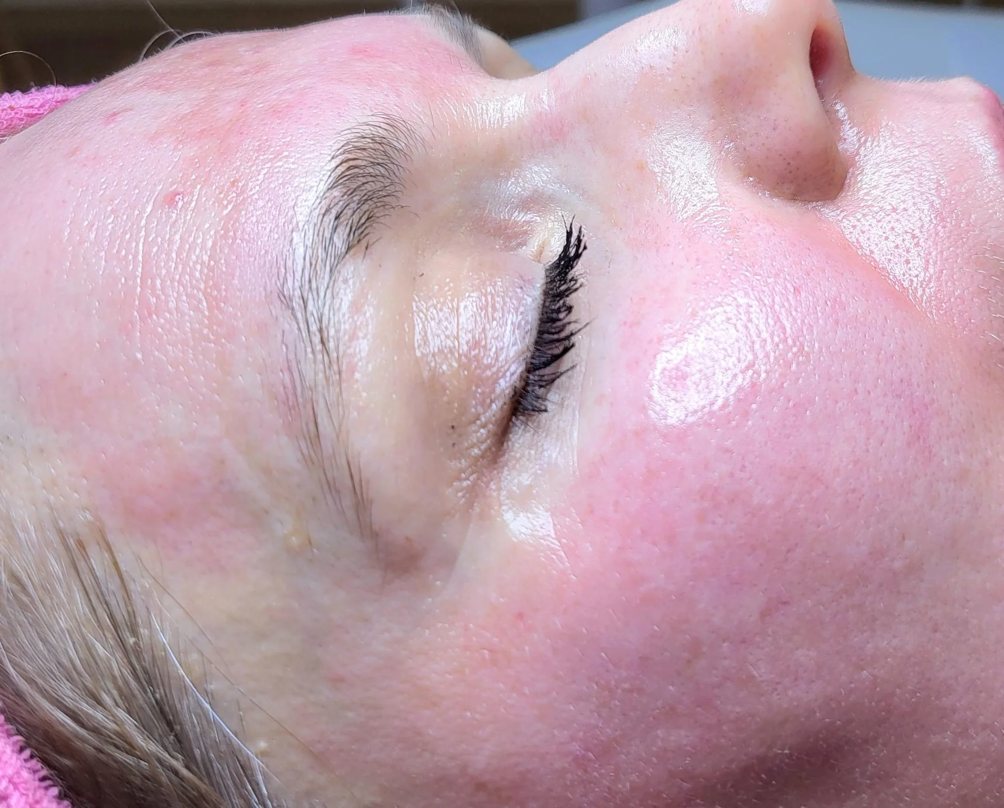 Mikrojehličkování nebo karbonový peeling pro omlazení a obnovu pleti