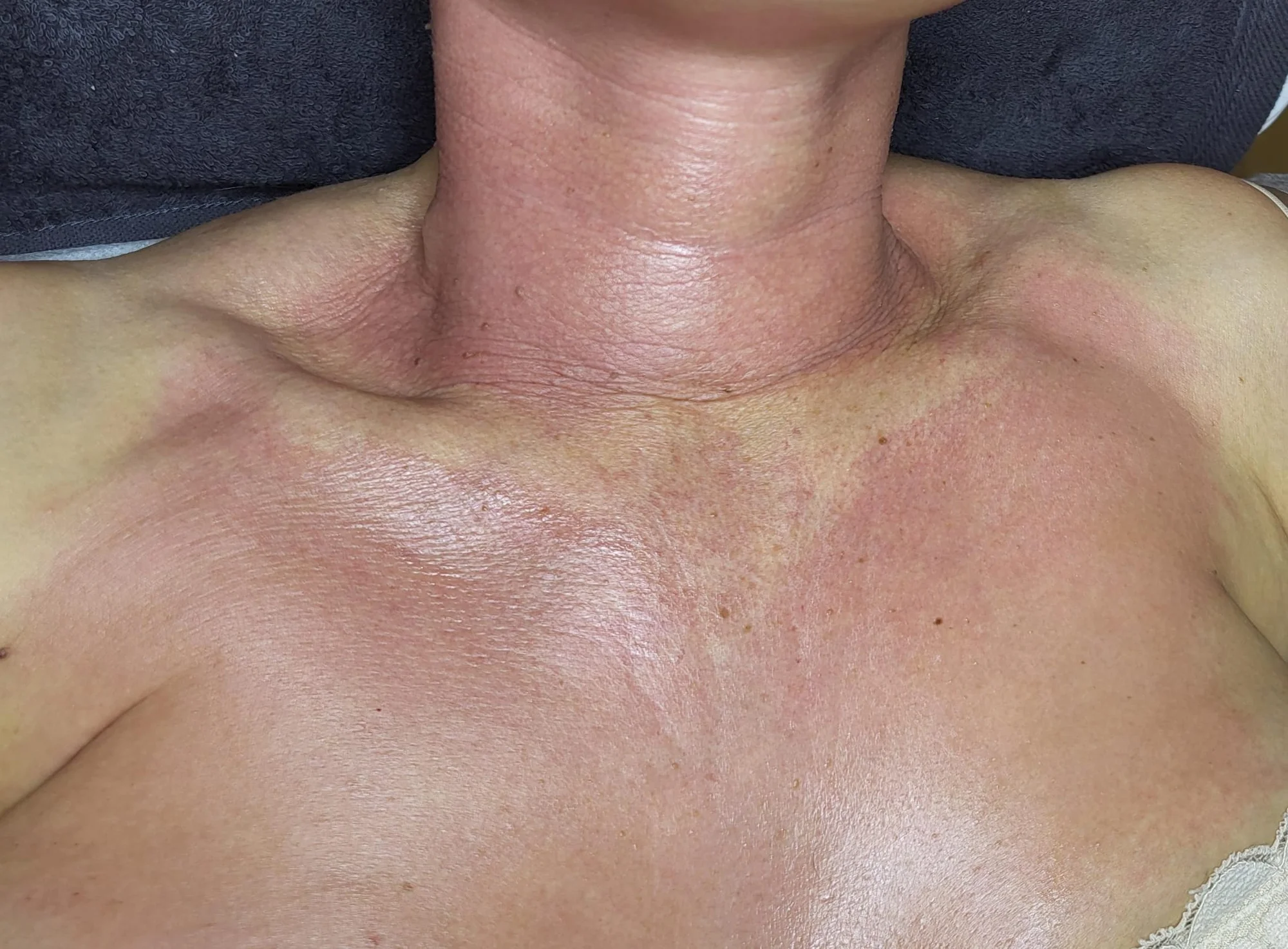 Mikrojehličkování nebo karbonový peeling pro omlazení a obnovu pleti