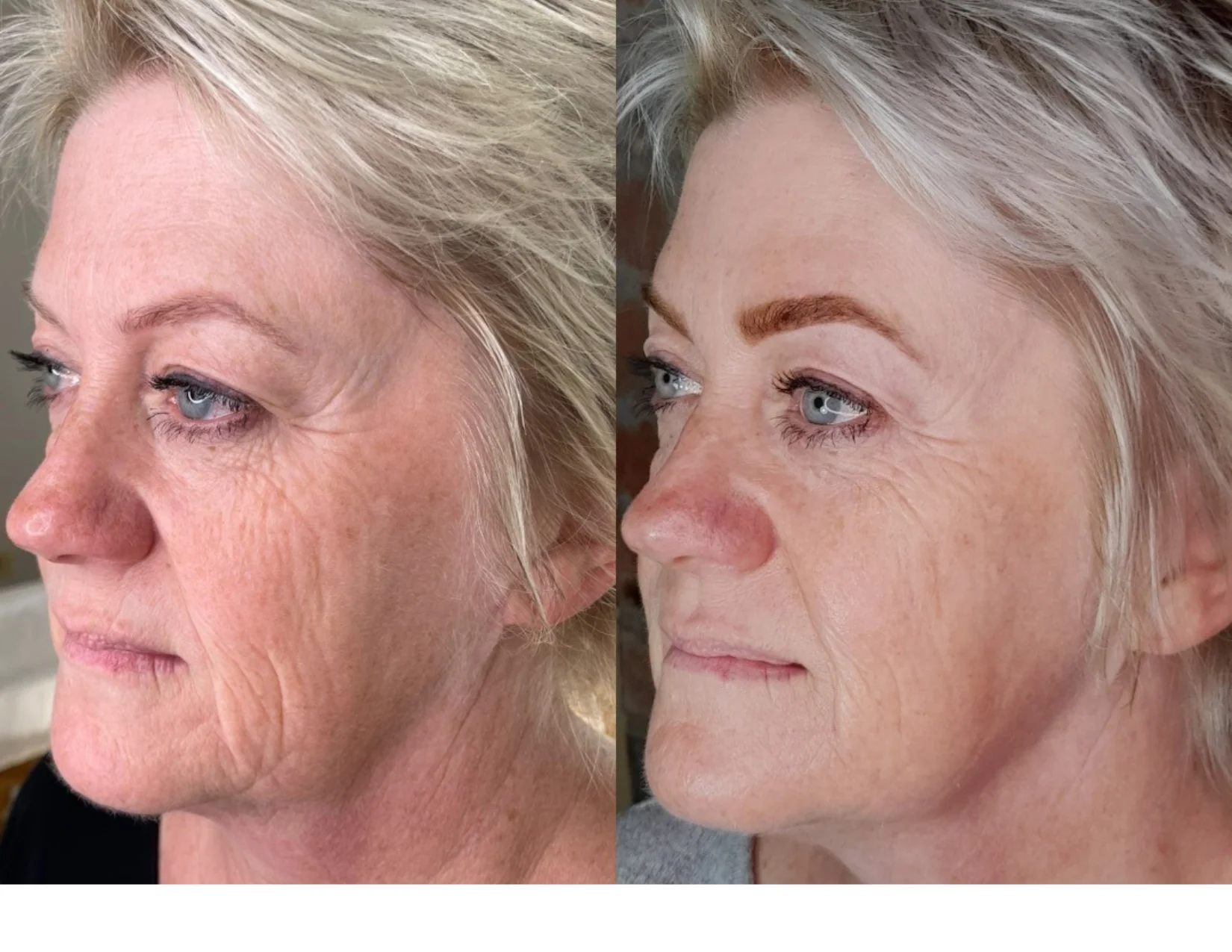 Pro hladkou pleť bez vrásek: ošetření studenou plazmou v luxusním estetickém studiu