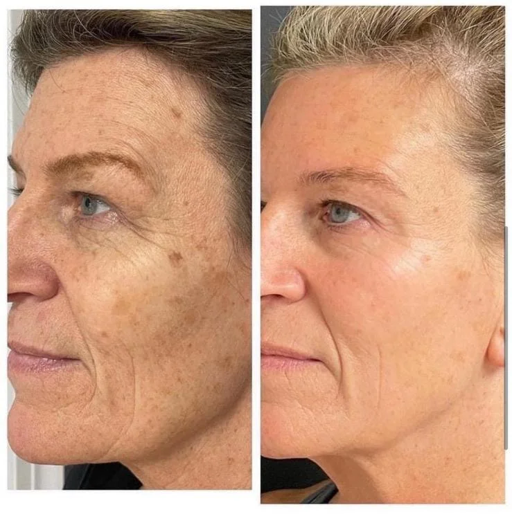 Pro hladkou pleť bez vrásek: ošetření studenou plazmou v luxusním estetickém studiu