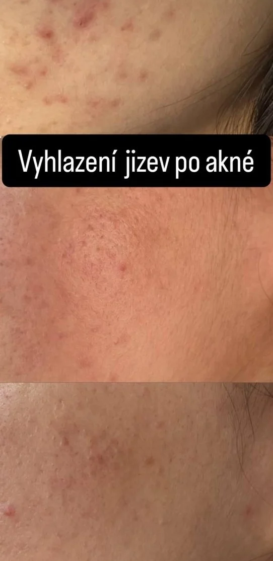 mikrojehličkovani