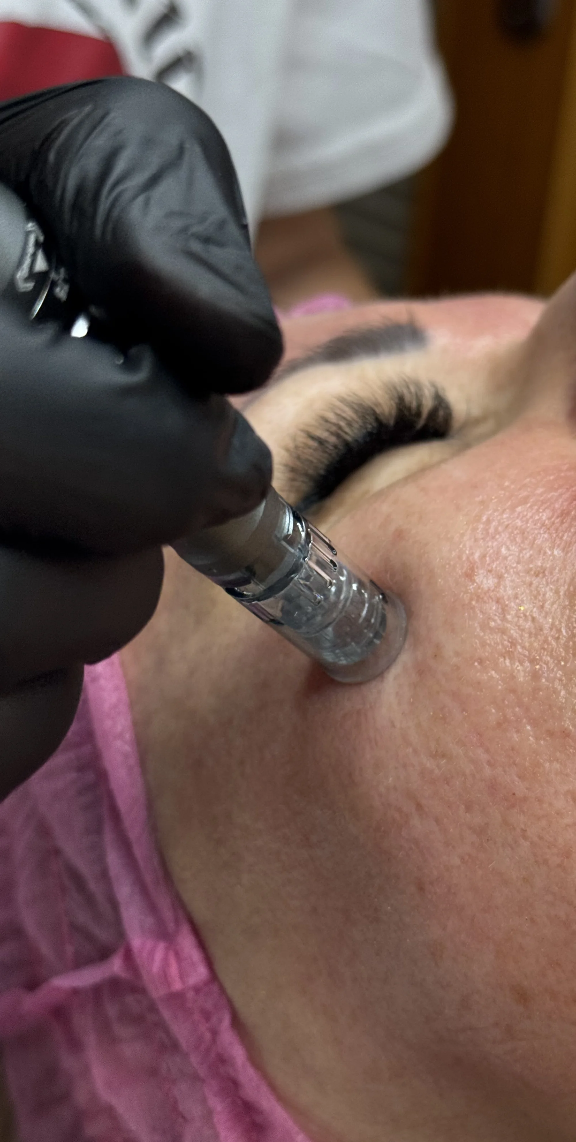 Mikrojehličkování s lososím DNA: revoluční péče pro obnovu pleti