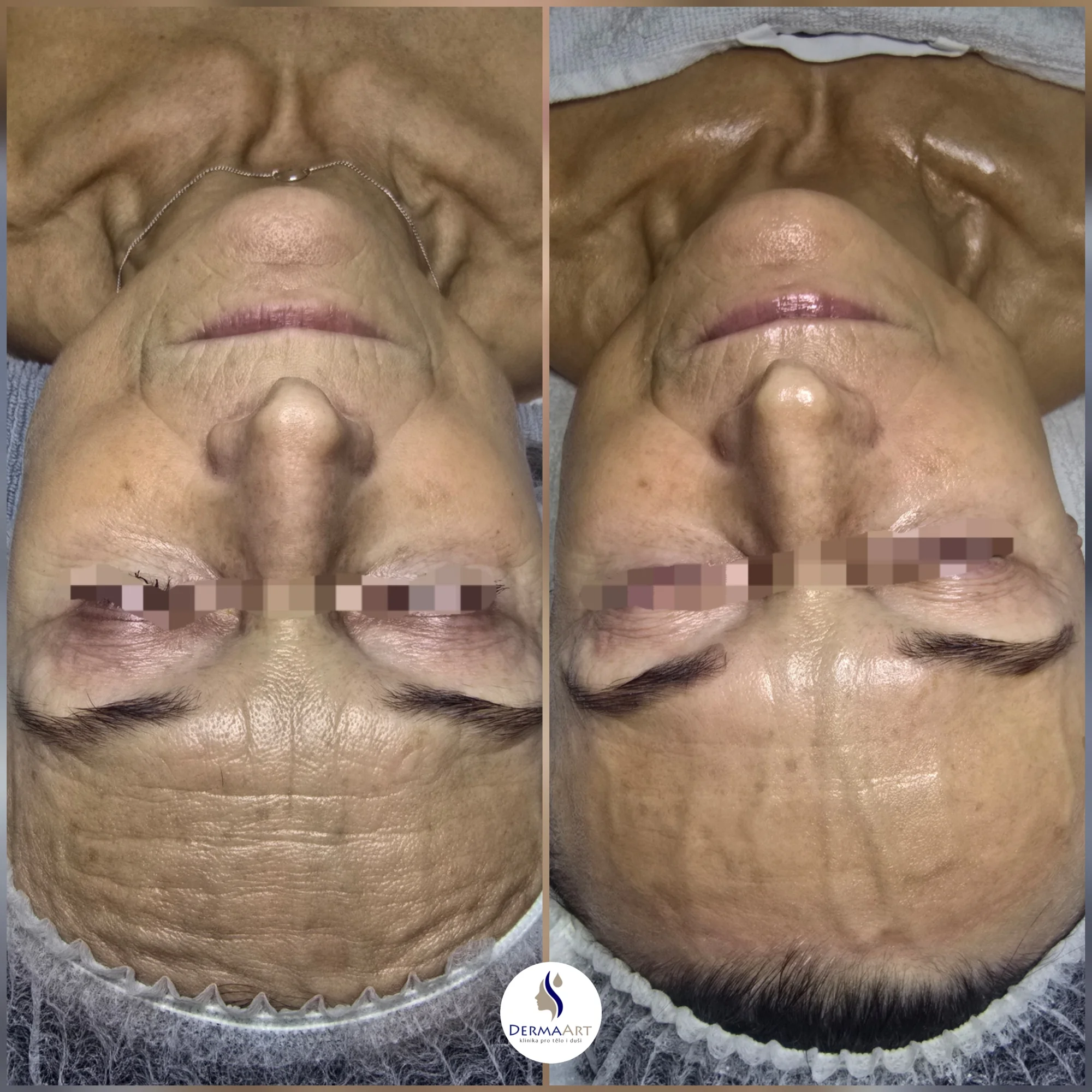 Profesionální péče o pleť: mikrojehličková terapie i studená plazma