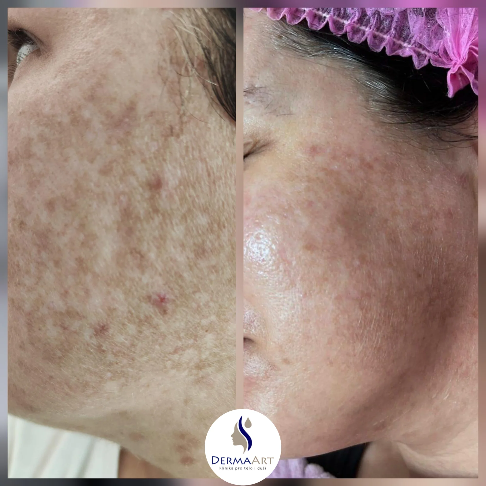 Profesionální péče o pleť: mikrojehličková terapie i studená plazma