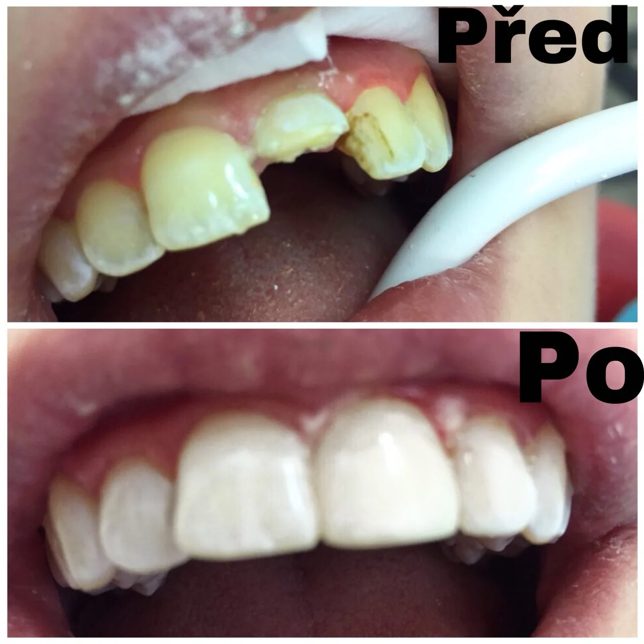 Dejte si spravit zub fotokompozitní plombou z nejkvalitnějšího materiálu