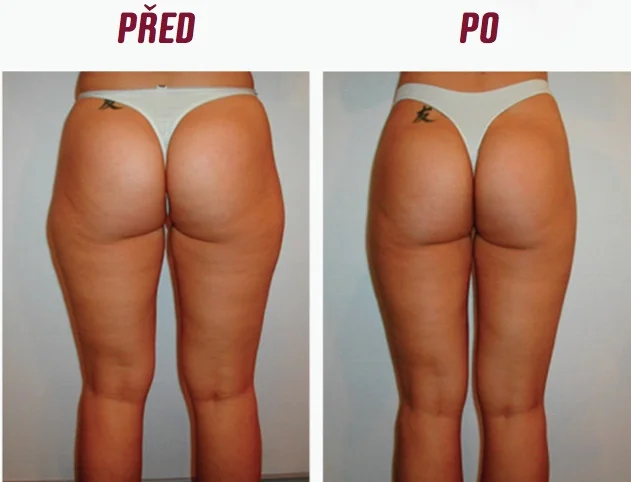 Přístrojová kalhotová lymfodrenáž pro krásné tělo a detoxikaci organismu: 1 až 15 procedur