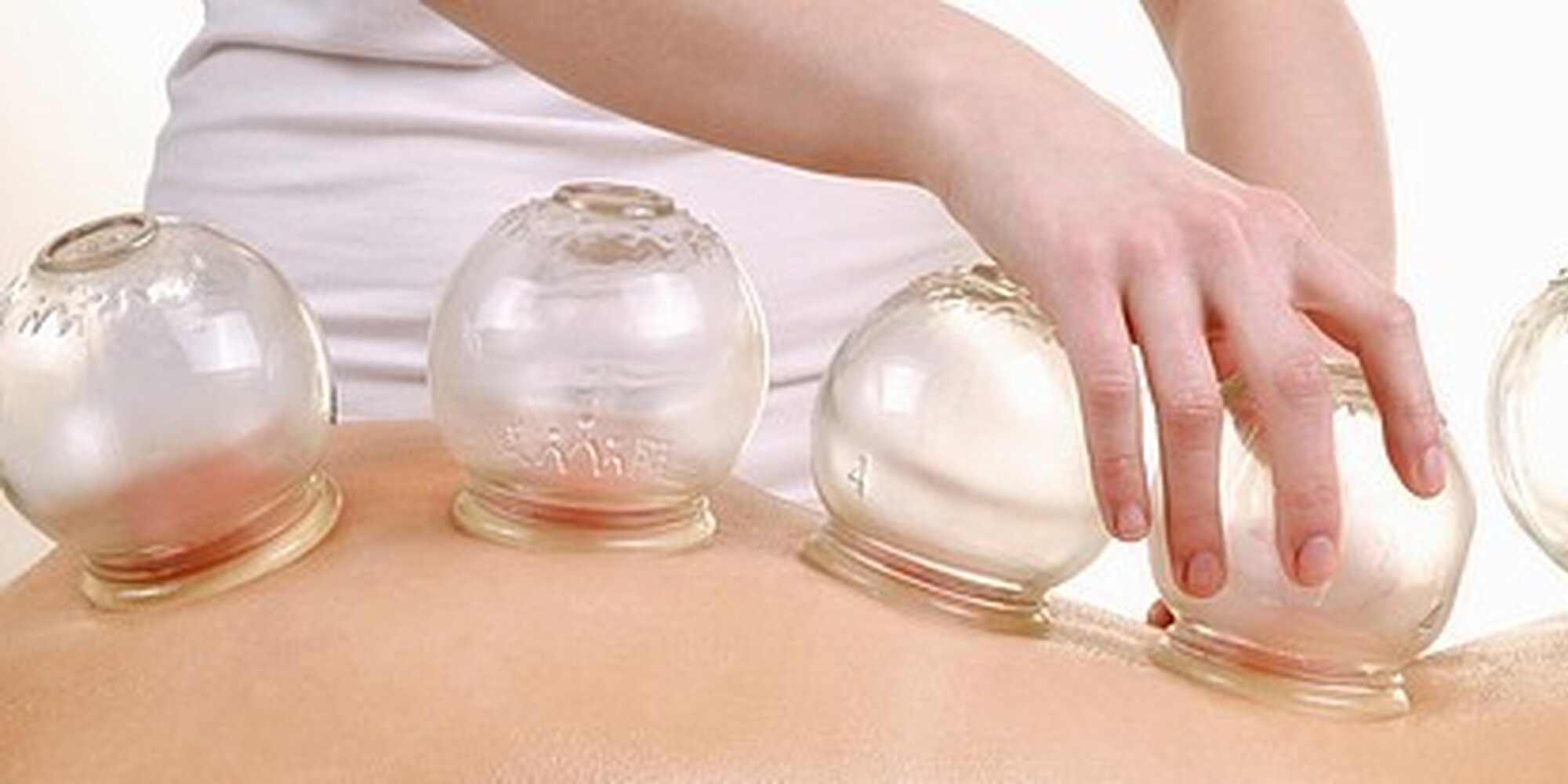 как ставить стеклянные банки. баночный массаж хиджама. банки медицинские стеклянные на спину. медицинский банки на спину.