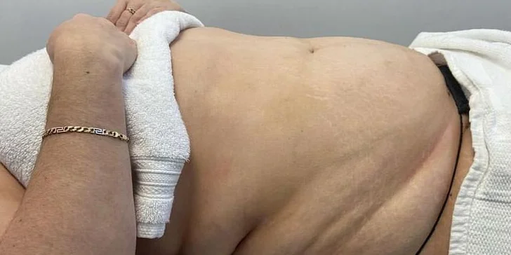 Pokud budete dodržovat pitný režim a dietní doporučení, zpravidla je po 1 proceduře úbytek 1kg