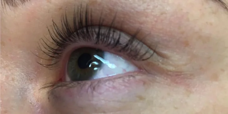 Botox mihalníc