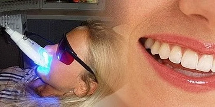 Neperoxidové bělení zubů metodou zvanou Smile Brilliant Teeth Whitening