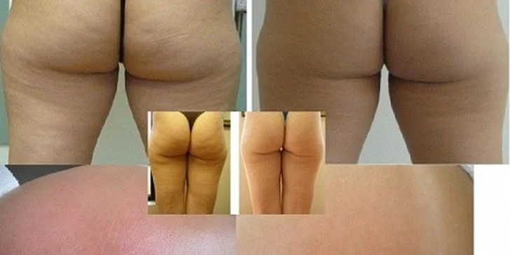 Stop celulitidě - zpevnění kůže a podkoží, omlazení pokožky