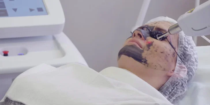 Zatočte s vráskami a nedokonalostmi pleti: ošetření karbonovým laserovým peelingem
