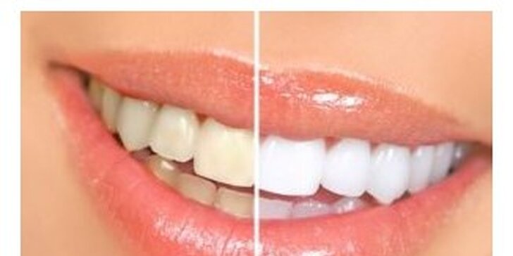 Pro váš zářivý úsměv: ordinační bělení Opalescence® Boost včetně dentální hygieny