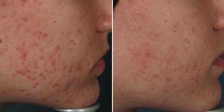 Dvoufázové odstranění akné i vrásek pomocí Face-Up a plazmových toků