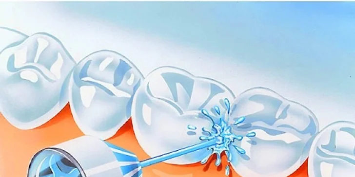 Dentální hygiena s air flow, ručním dočištěním a prohlídkou u lékaře