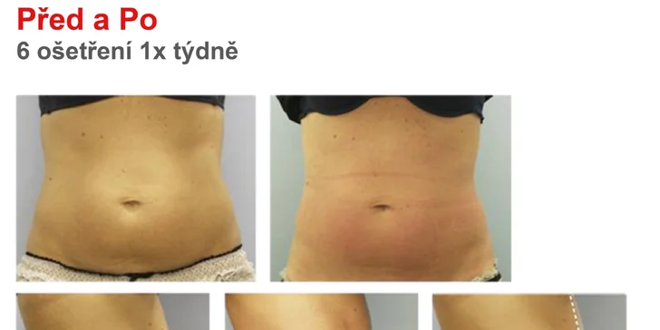 Přístrojová lymfodrenáž: 1 nebo 5 procedur pro lepší postavu