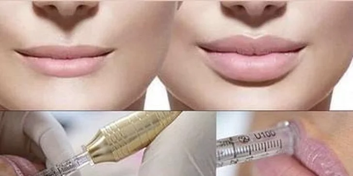 Zvětšení rtů a výplň vrásek pomocí Hyaluron pen: 1-5 aplikací