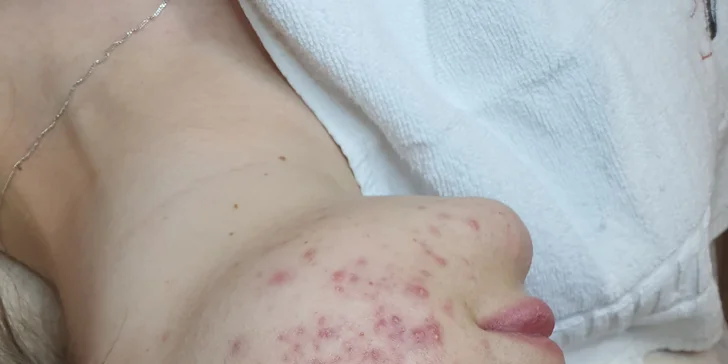 Lasocare® nejen léčí aknetické projevy, ale pomáhá i přecházet vzniku akné.