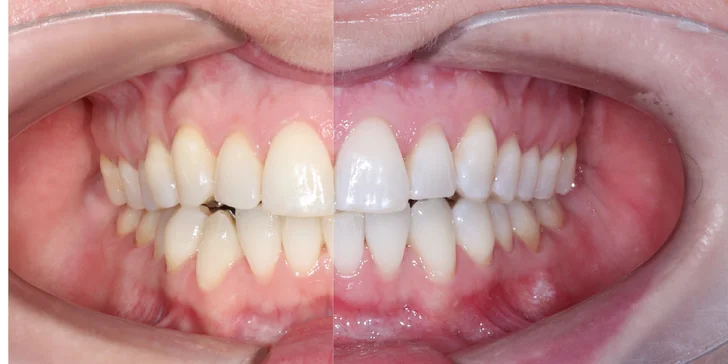 Bezbolestné ordinační bělení zubů a dentální hygiena pro děti i dospělé