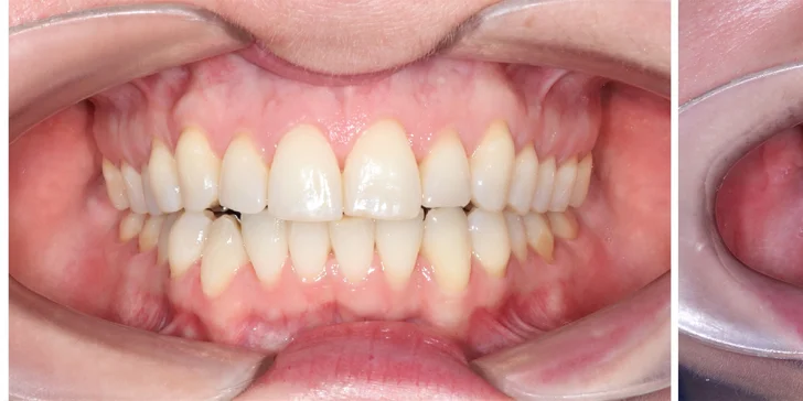 Bezbolestné ordinační bělení zubů a dentální hygiena pro děti i dospělé