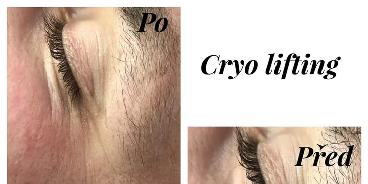 Omlazení obličeje: Cryo Lifting pro rozjasnění pleti včetně masáže obličeje