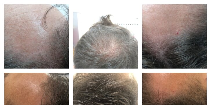 Bojujte s řídnoucími vlasy: 1–6 ošetření mezoterapií i s kmenovými buňkami