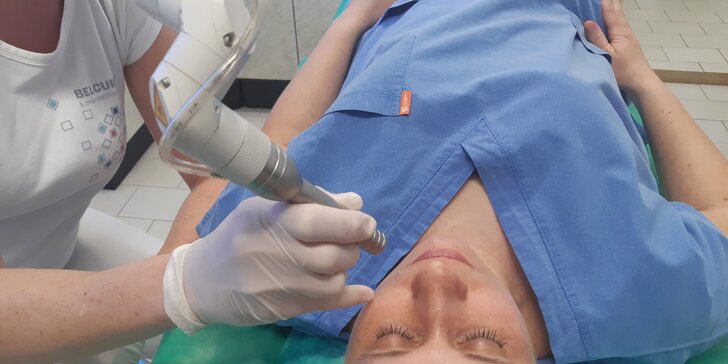 Zbavte se nežádoucích chloupků: trvalá epilace horního rtu pomocí laseru
