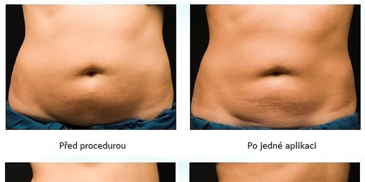 Kryolipolýza lékařským přístrojem: jedno, tři nebo pět ošetření