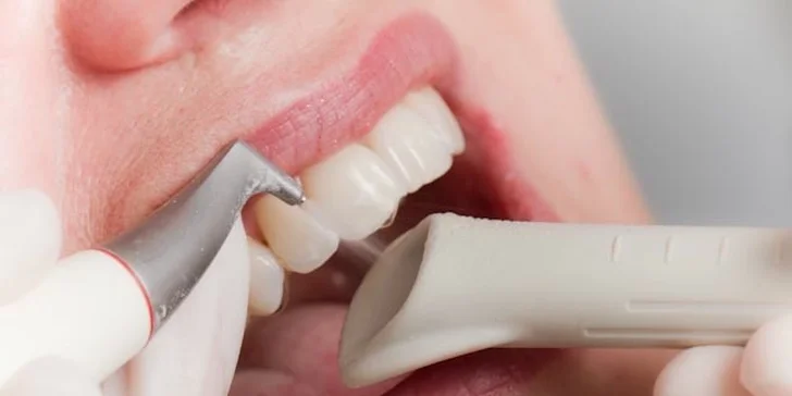 Dentální hygiena s air flow, ručním dočištěním a prohlídkou u lékaře