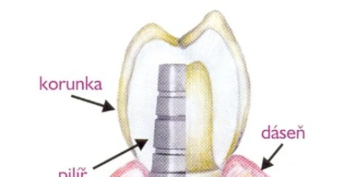 Profi zubní péče: vysoce kvalitní implantát a případně i nasazení korunky nebo můstku